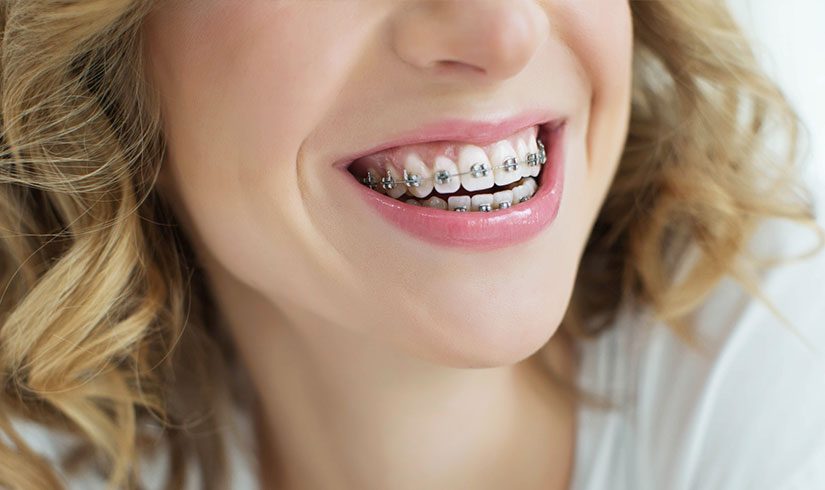 La Importancia de la Ortodoncia Fija en la Salud Dental